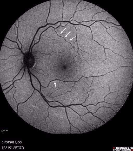 Figure 4. Cliché en autofluorescence où l’on peut observer des lignes hyper-autofluorescentes parallèles aux gros vaisseaux, correspondant aux zones d’épithélium pigmentaire où étaient localisés les gros vaisseaux avant la chirurgie.
