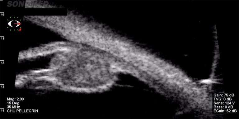 Figure 6. Mélanome ciliaire en UBM (sonde 35 MHz, VUmax, Sonomed, New York). Masse développée au sein du corps ciliaire : limites floues, d’échogénicité hétérogène, refoulant vers l’avant l’iris, sans infiltration sclérale.
