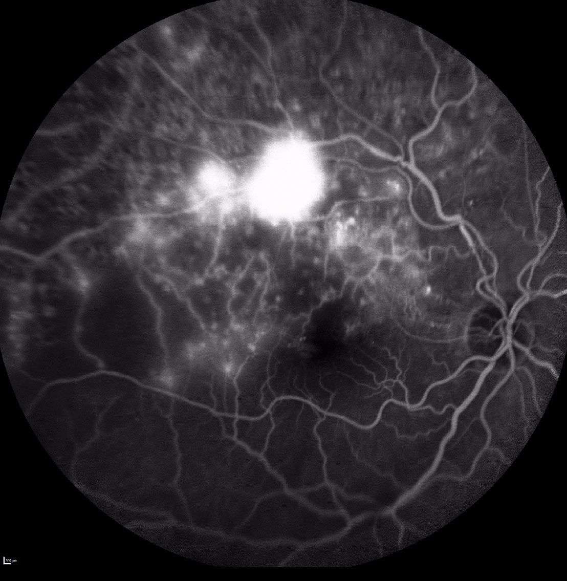 Figure 2. Cliché d’angiographie à la fluorescéine aux temps intermédiaires. Visualisation de 2 bouquets néovasculaires prérétiniens en regard de l’arcade temporale supérieure.
