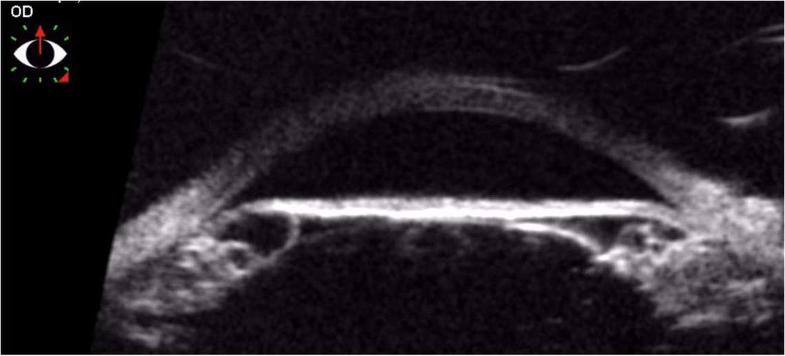 Figure 2. UBM en coupe axiale mettant en évidence une fermeture angulaire sur iris plateau secondaire à une polykystose iridociliaire.
