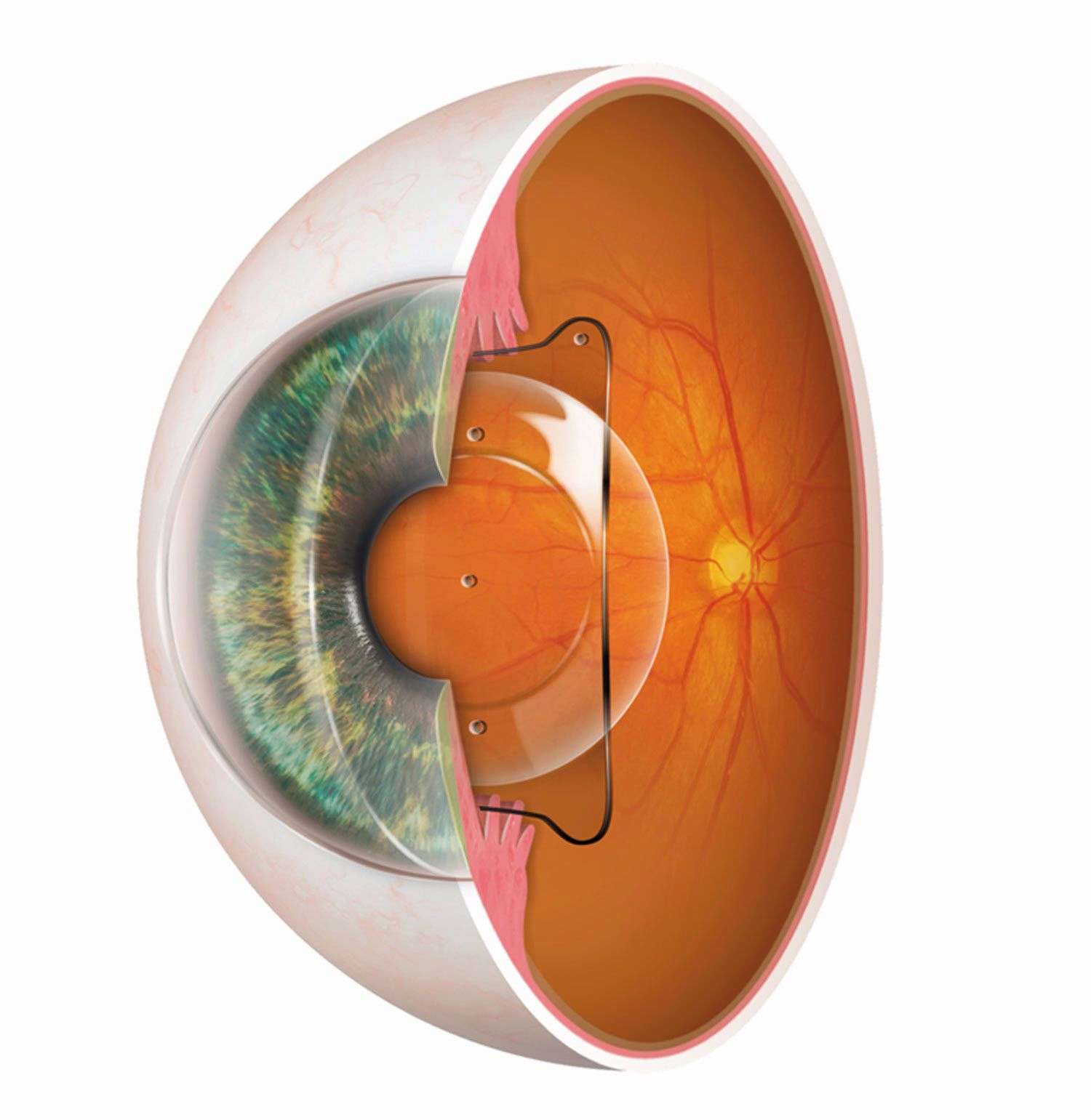 Figure 2. L’implant ICL est positionné en arrière de l’iris et en avant du cristallin.
