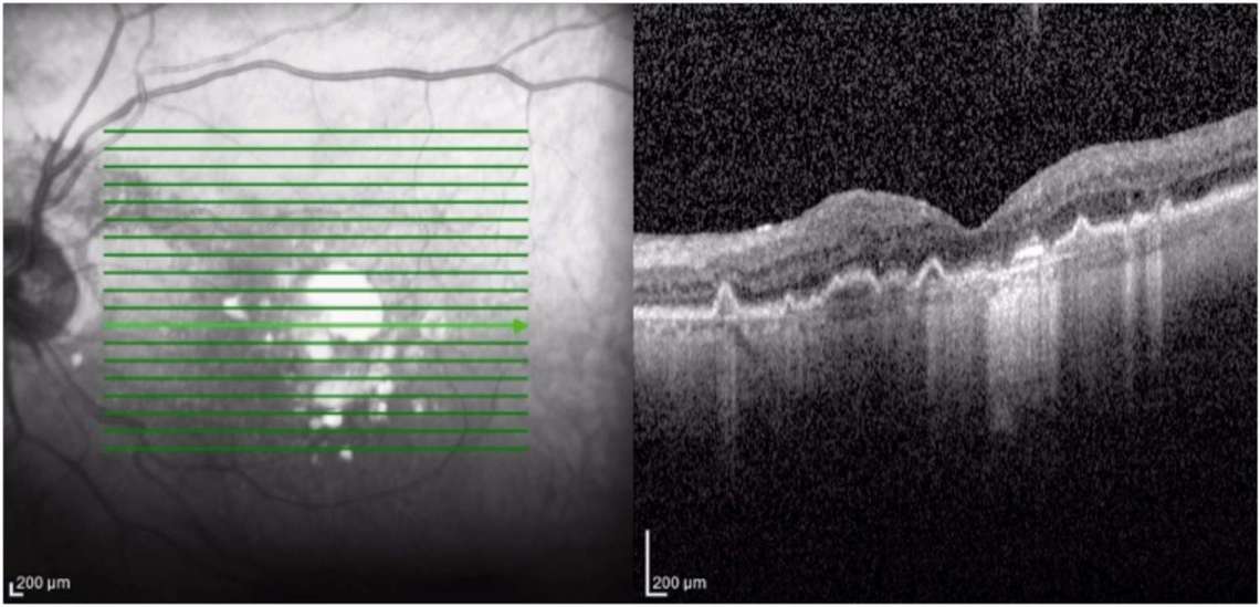 Figure 4. OCT maculaire. 5 mois après l’hémorragie, et après la chirurgie de la cataracte, l’OCT ne présente pas de signes exsudatifs, l’intervalle entre les IVT est augmenté, l’acuité visuelle est de 5/10.
