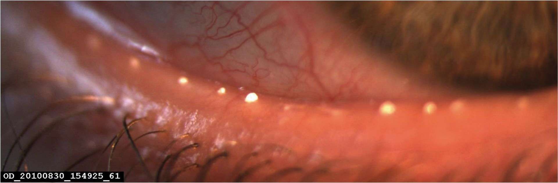 Figure 1. Illustration obstruction meibomienne avec matériel très dense à expression difficile.
