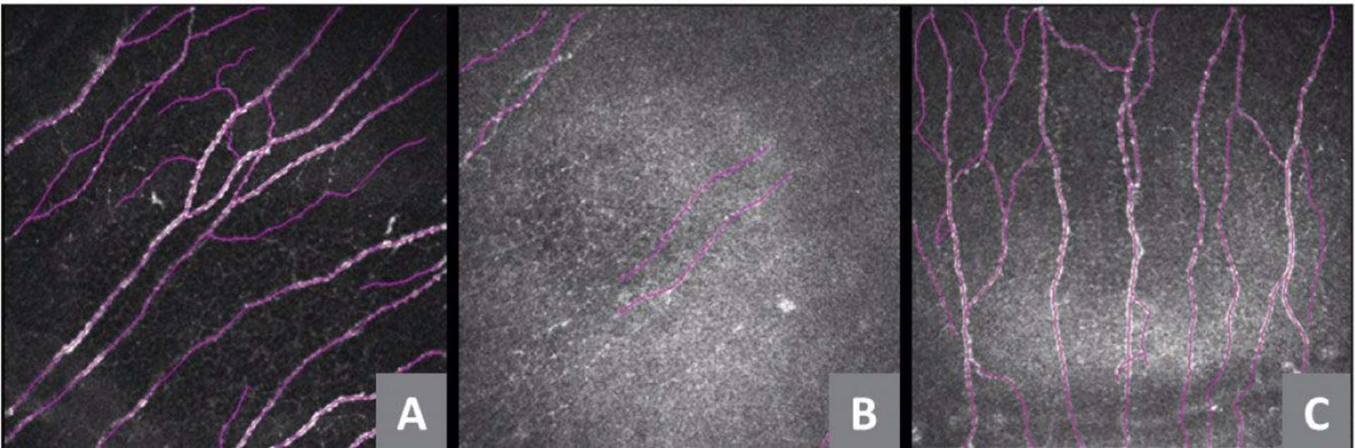 Figure 3. Innervation cornéenne visualisée en microscopie  confocale avant (A) et après (B à 1 mois et C à 12 mois) un CXL conventionnel. L’analyse retrouve une dénervation significative après un CXL, la densité du plexus sous-basal retrouve son état basal après 12 mois. 
