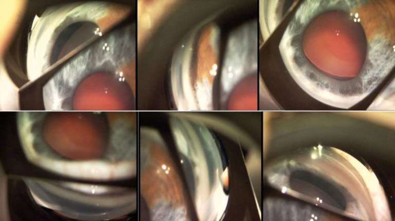 Examen gonioscopique de l’œil droit : anomalie de migration pigmentaire au niveau du trabéculum, goniosynéchie temporale supérieure et hétérochromie.
