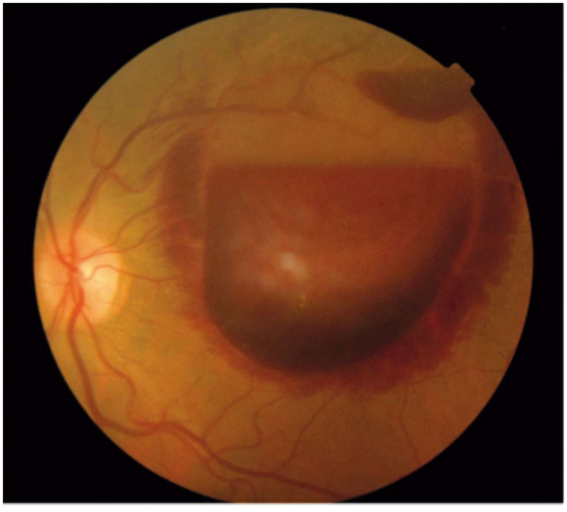 Figure 1. A. Fond d’œil gauche : hématome rétro-hyaloïdien prémaculaire suspendu. 
