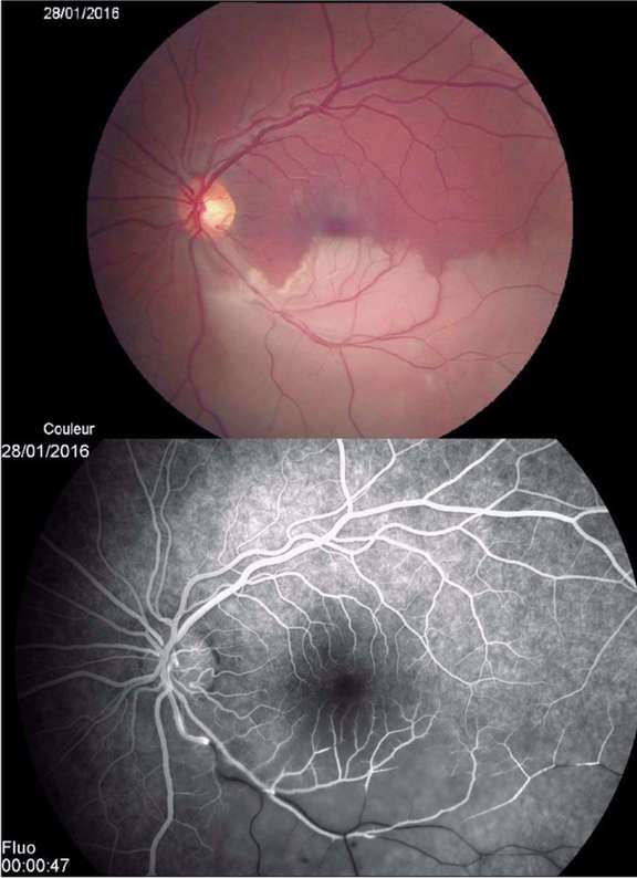 L’occlusion de branche artérielle rétinienne temporale de l’œil gauche est clairement visualisable sur la rétinophoto avec un œdème blanc caractéristique de la zone infarcie.
