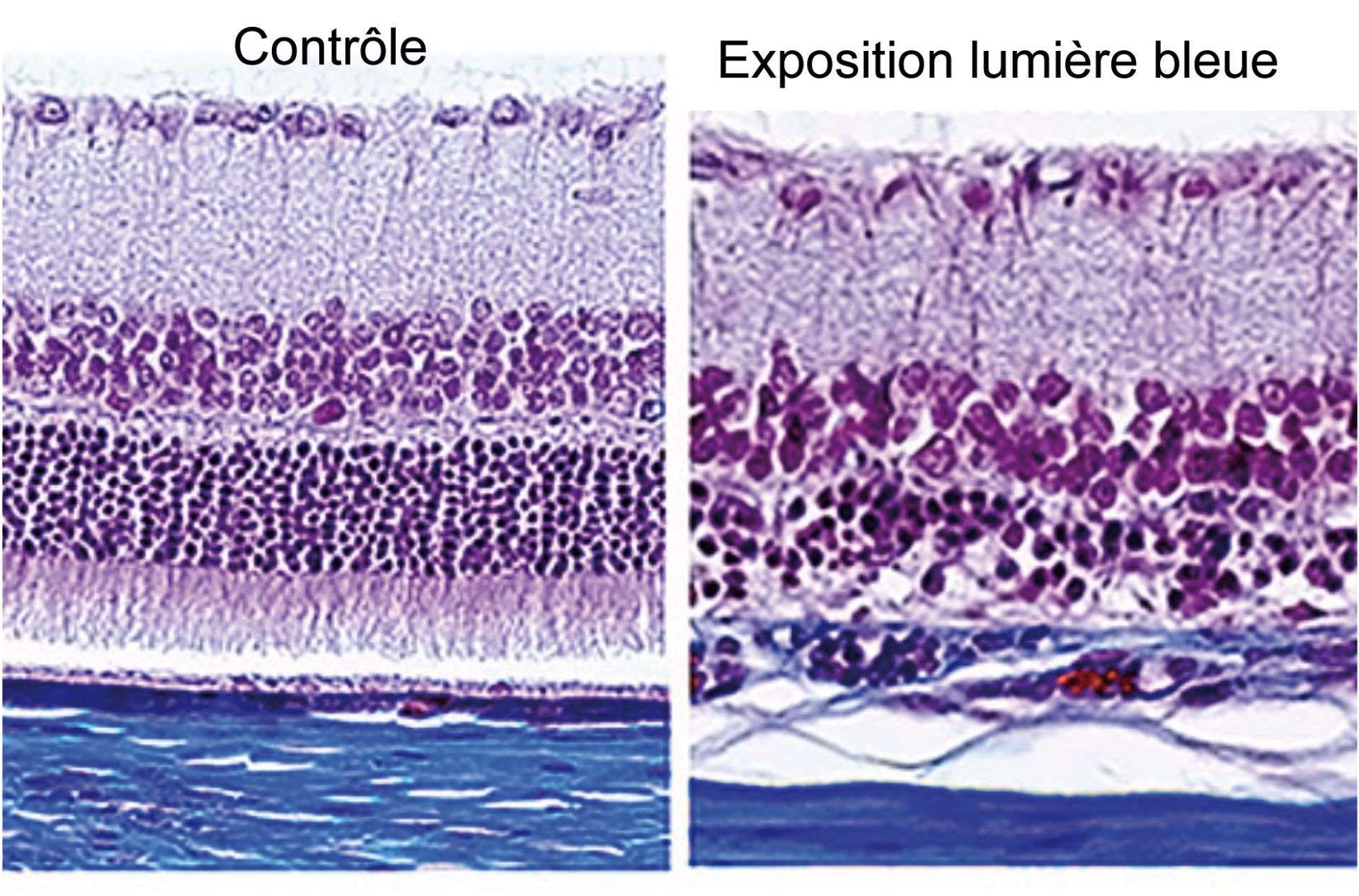 Notez l’importance de l’altération de la couche des photorécepteurs
