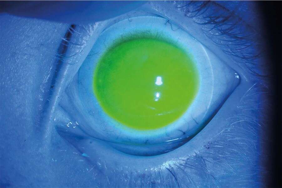 Figure 3. Photo en lumière bleue&nbsp;de l’œil gauche&nbsp;adapté&nbsp;en lentilles sclérales : bon centrage, pas d’appui central, bon appui scléral.
