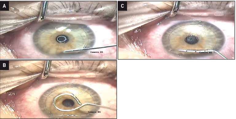 Figure 5. A. Réalisation d’un volet cornéen au laser femtoseconde. B. Positionnement du lenticule en inlay sur le centre pupillaire. C. Repositionnement du volet cornéen.
