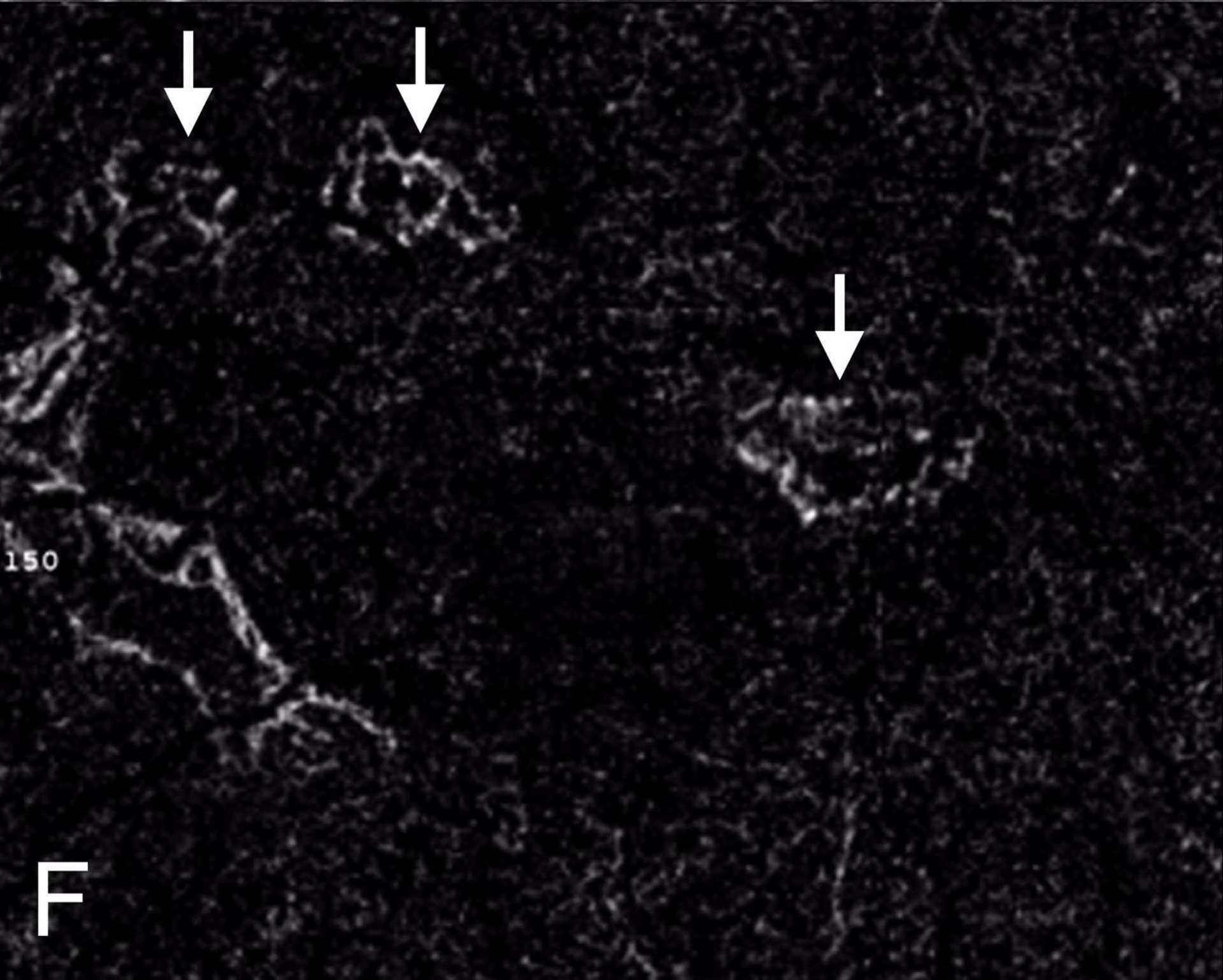 Au sein de ces nombreuses lésions hyperfluorescentes aux temps précoces avec diffusion tardive, seules trois lésions présentent une image de flux anormal néo vasculaire sur l’OCT-A segmenté au niveau de la rétine externe
