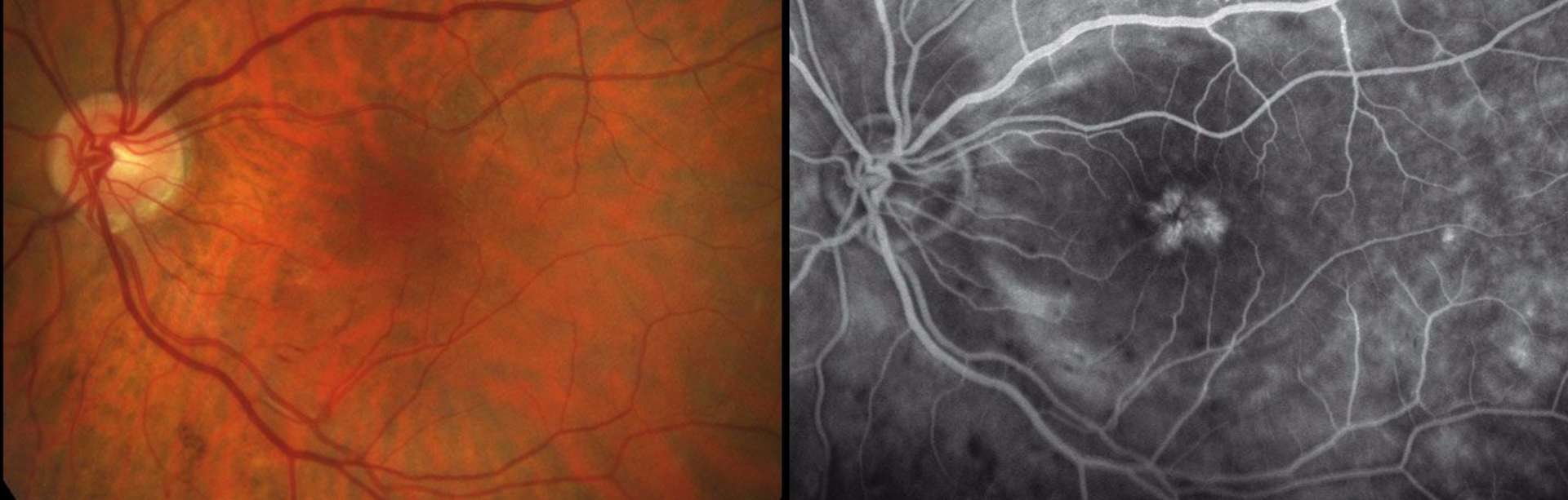 Figure 2. Aspect angiographique d’un syndrome d’Irvine-Gass. On remarque des dilatations capillaires périfovéolaires et des diffusions symétriques qui s’étendent au-delà de l’aire maculaire et des vaisseaux temporaux. On note un aspect « pétaloïde » des kystes maculaires.
