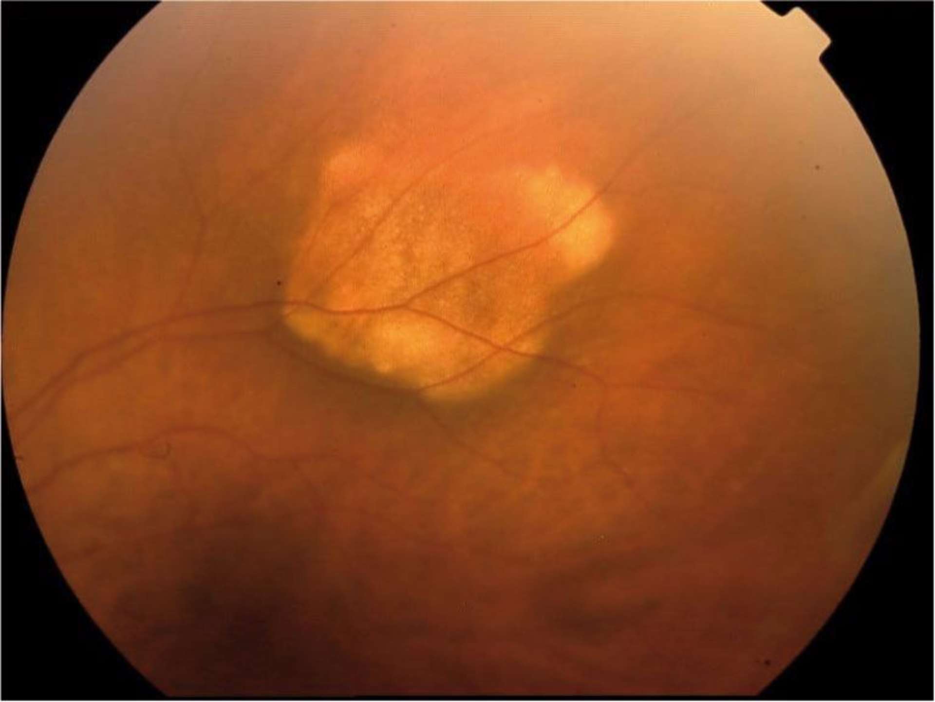 Calcifications choroïdiennes idiopathiques
