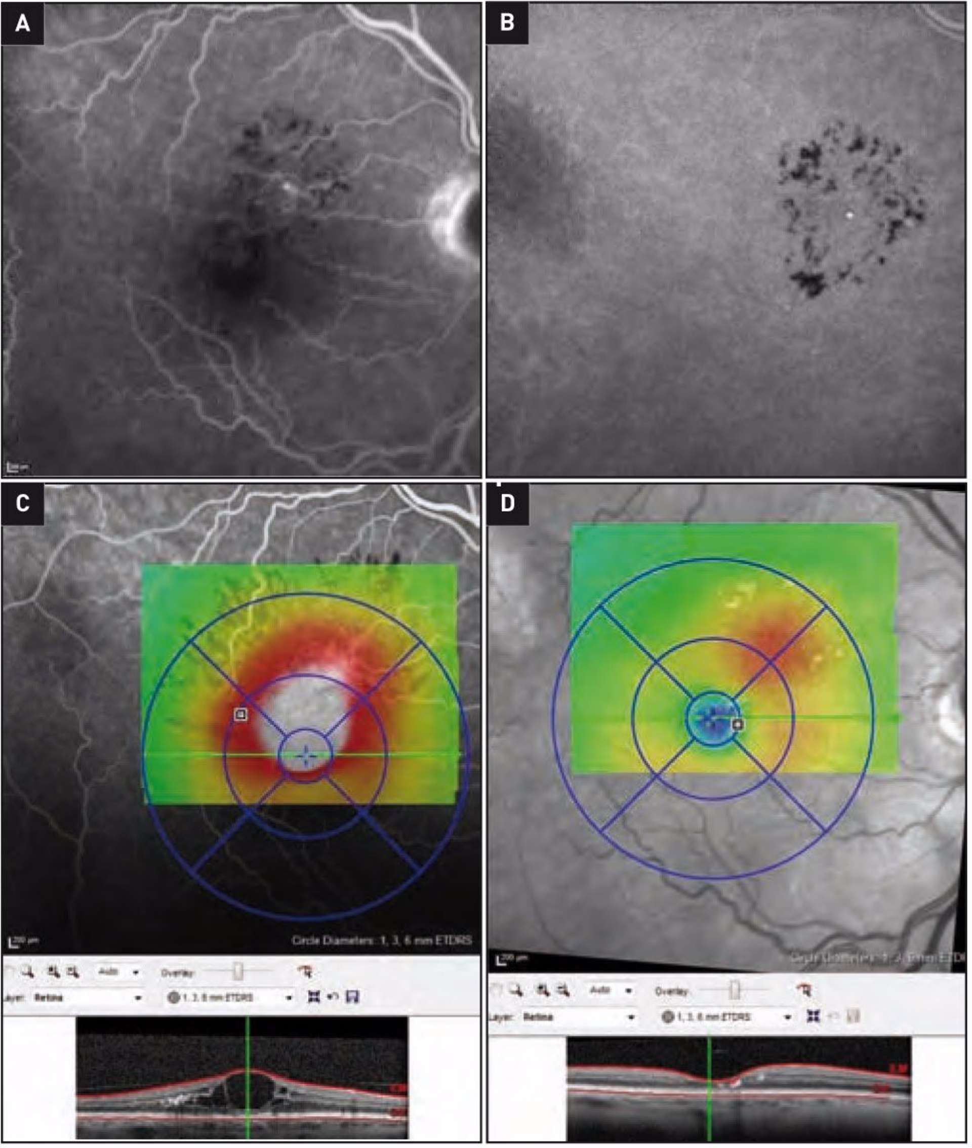 Figure 3. Occlusion de branche veineuse ancienne chez un homme de 64 ans, laser focal. Le macroanévrysme capillaire est bien visible sur l’angiographie à la fluorescéine (A) et au vert d’infracyanine (B), donnant un œdème maculaire avec grosse logette centrale (C). Deux mois après un laser focal, l’œdème a régressé et il reste encore quelques exsudats lipidiques (D).
