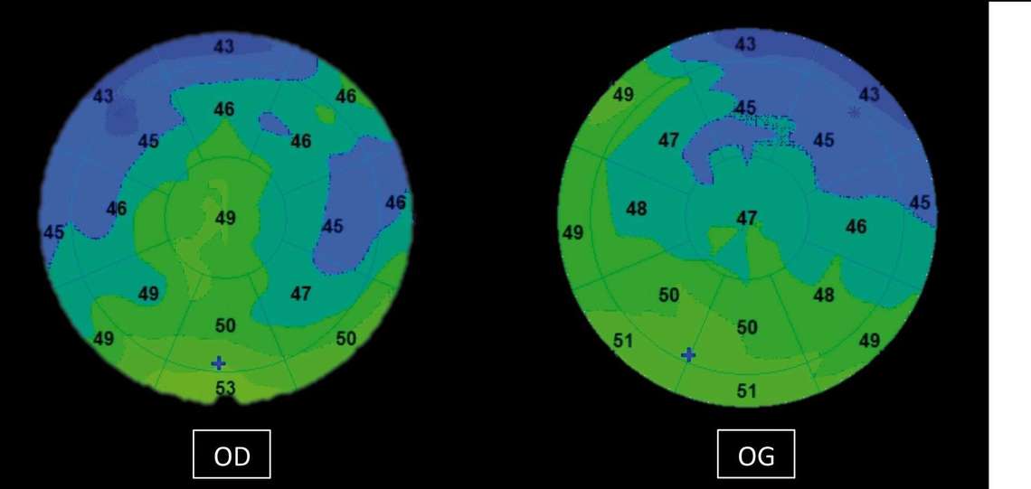 Figure 6. Topographie épithéliale d’un patient présentant une sécheresse modérée avec un BUT à 8 secondes. On observe un amincissement notable de l’épithélium cornéen en supérieur, avec une distribution irrégulière témoin de cette surface oculaire pathologique.
