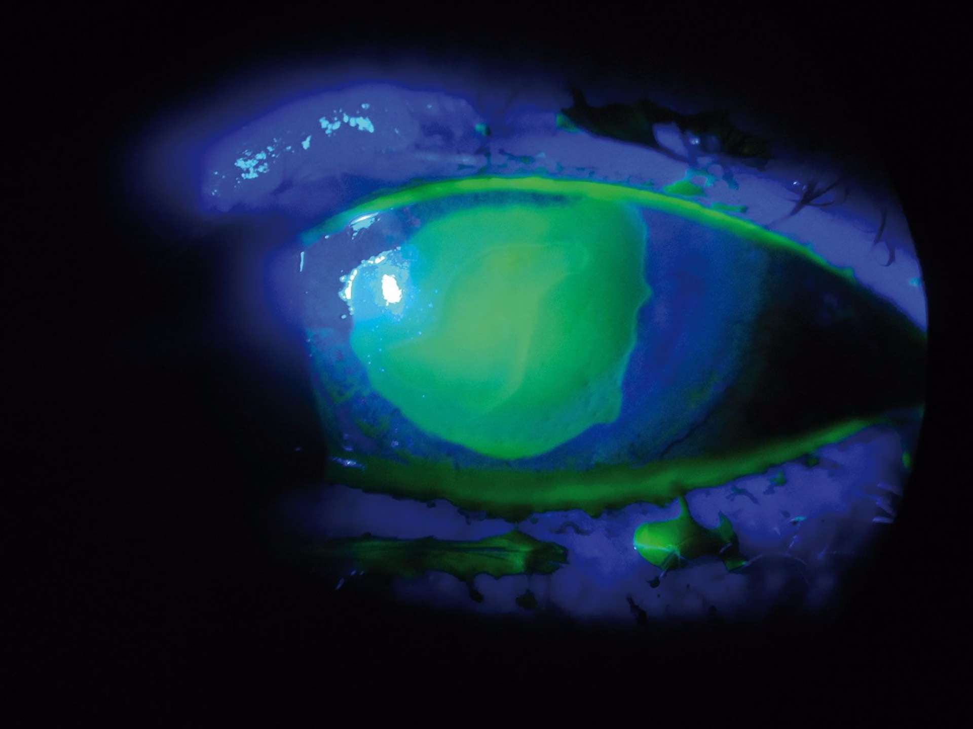 Figure 2. B. Ulcère précédent mis en évidence par une coloration à la fluorescéine.
