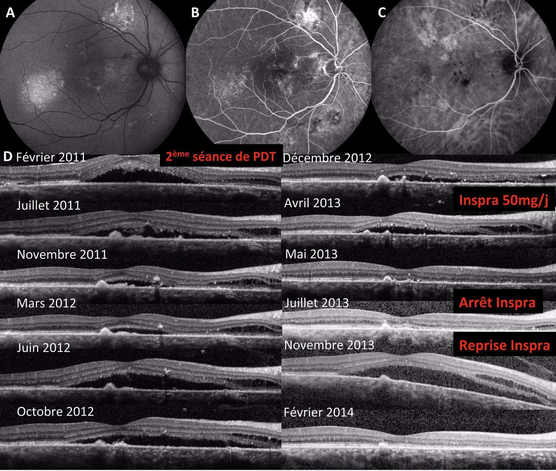 Patient de 49 ans atteint de CRSC chronique bilatérale. L’œil droit a déjà été traité par du laser focal en 2009 ainsi qu’une séance de PDT en 2010
