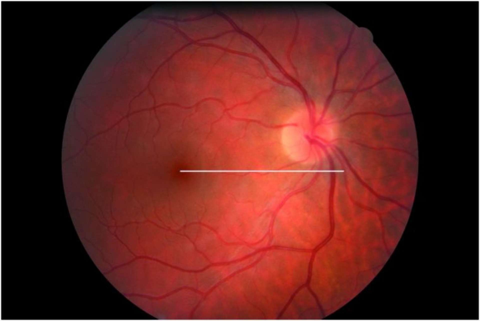 Paralysie unilatérale du muscle oblique supérieur droit acquise secondairement à un méningiome de l’angle ponto-cérébelleux chez une femme de 44 ans. Rétinophotographie OD : excylotorsion
