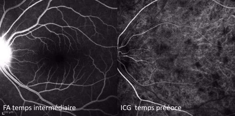 Figure 6. Sarcoïdose oculaire. L’ICG montre des lésions choroïdiennes hypofluorescentes (granulomes) aux temps précoces qui restent invisibles à l’angiographie à la fluorescéine.
