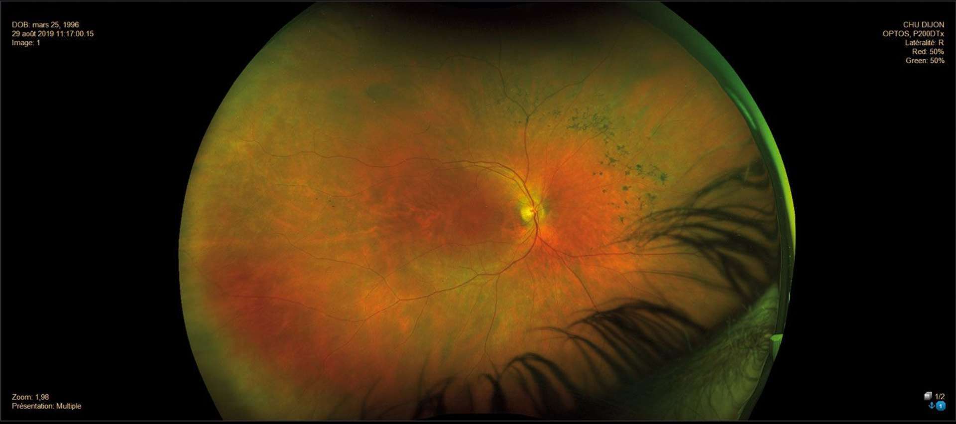 Figure 4. Rétinophotographie grand champ d’un patient présentant une maculopathie cystoïde secondaire à une rétinite pigmentaire.
