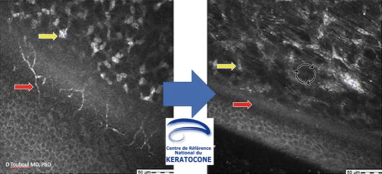 Figure 1. Imagerie en microscopie confocale de la jonction épithélium/stroma cornéen avant et après (M1) CXL EPI-ON OBXL. Épithélium normal, déplétion des plexus nerveux et disparition de la visibilité des noyaux des kératocytes à M1 post-op (images David Touboul).

