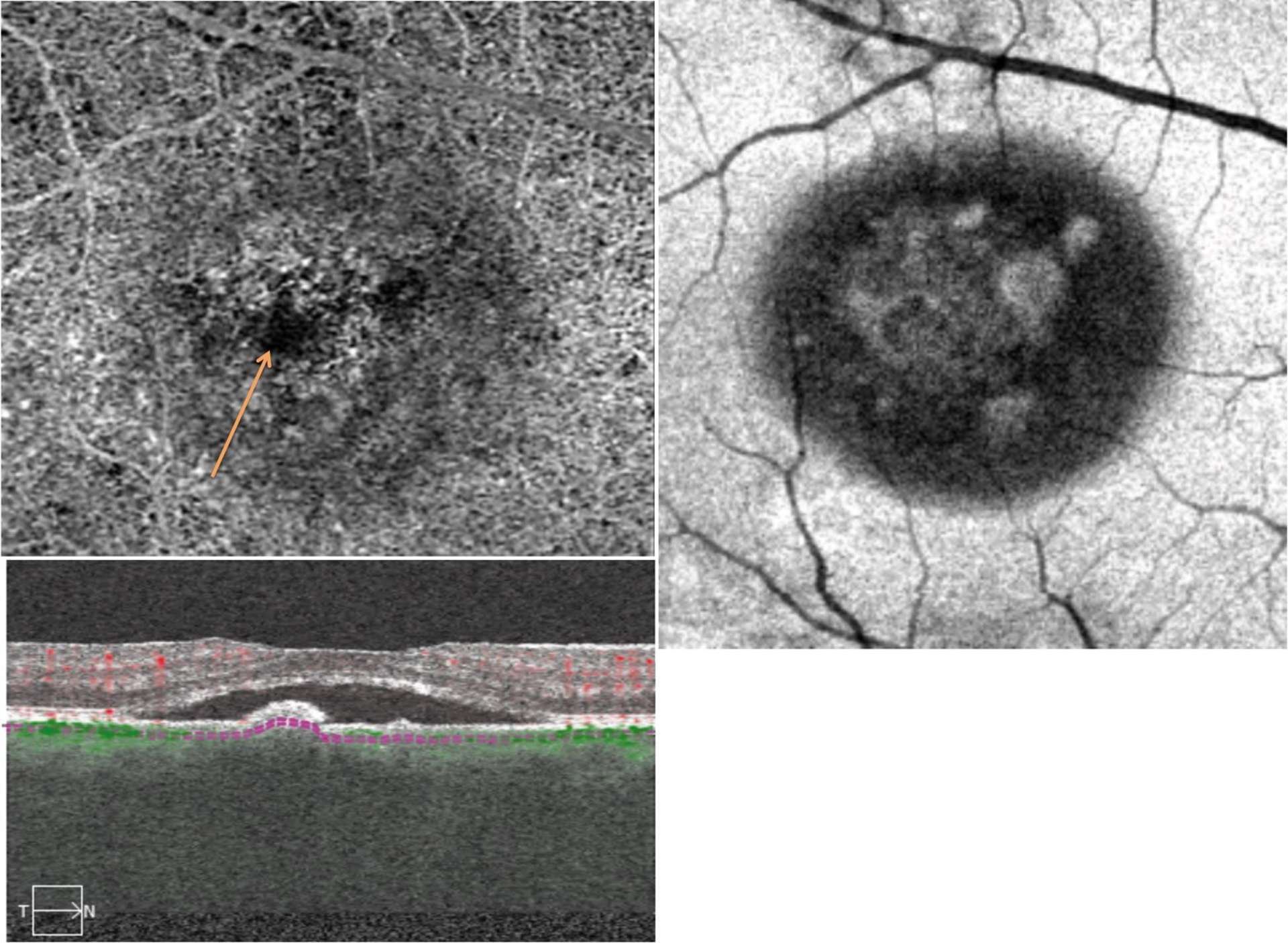 À l’OCT-A on observe une « dark area ».
