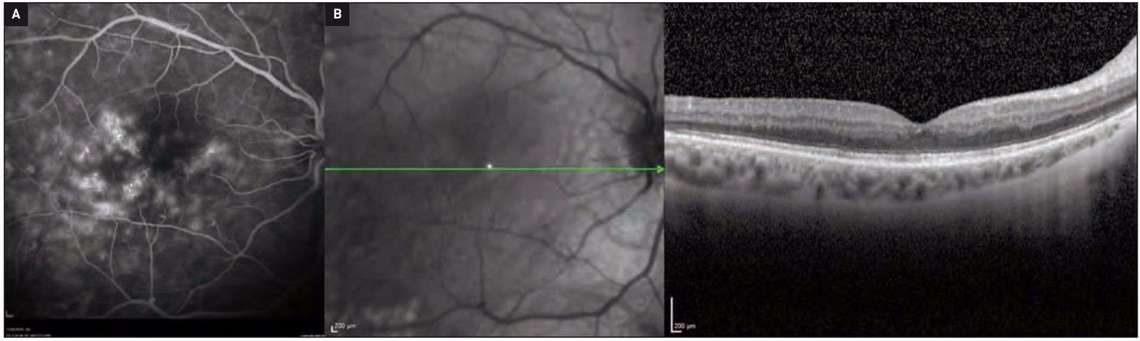 Figure 4. A. Angiographie à la fluorescéine d’une rétinopathie diabétique avec diffusion de colorant dans la région maculaire. B. L’OCT correspondant ne révèle pas d’épaississement rétinien, la patiente est cependant gênée par une acuité visuelle qui plafonne à 7/10.
