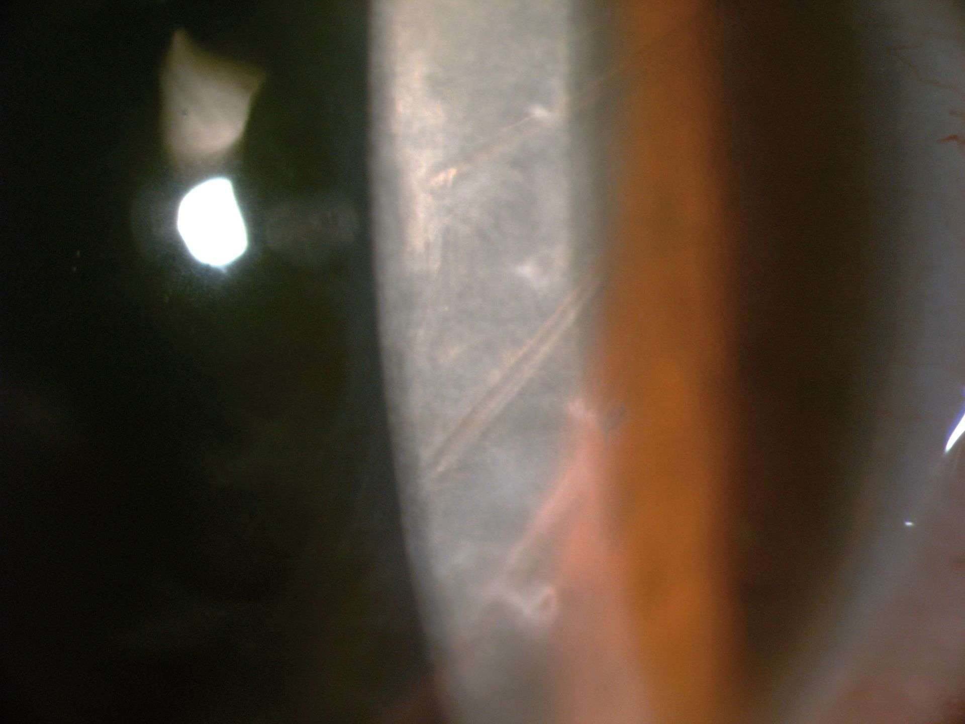Figure 2. Cornée périphérique de l’œil gauche. Les ruptures de la membrane de Descemet (stries de Haab) sont bien visibles alors que le greffon présente une membrane de Descemet intacte.
