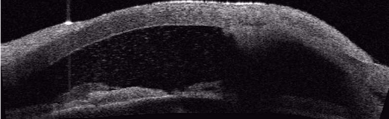 Abcès de cornée grave, profond, lors de l’hospitalisation du patient. L’infiltration cornéenne apparaît comme une zone hyperréflective en OCT haute résolution. On note la présence de fibrine dans la chambre antérieure, un hypopion et un ptérygion en nasal.
