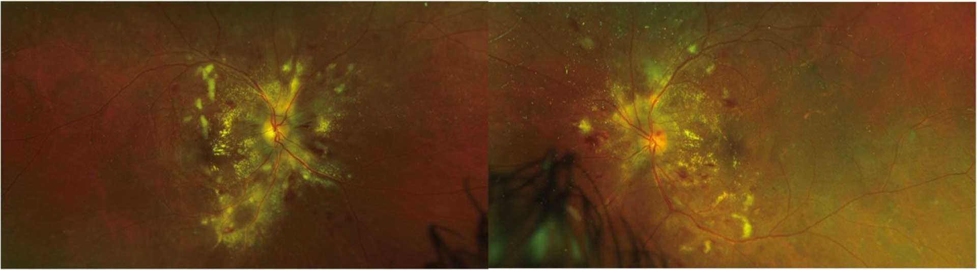 Figure 1. Photographie grand champ (Optos) du fond d’œil retrouvant un œdème papillaire, des hémorragies multiples, des exsudats secs et des nodules cotonneux. 
