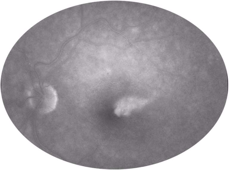 Figure 4. Cliché tardif (17 minutes) de l’angiographie à la fluorescéine OG montrant la diffusion du produit de contraste au niveau de la macula, signant l’œdème maculaire.
