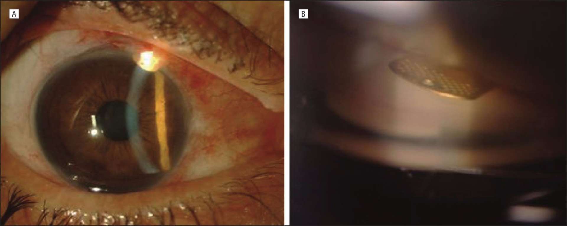 Vue biomicroscopique (a) et gonioscopique (b) d’un implant Goldshunt.
