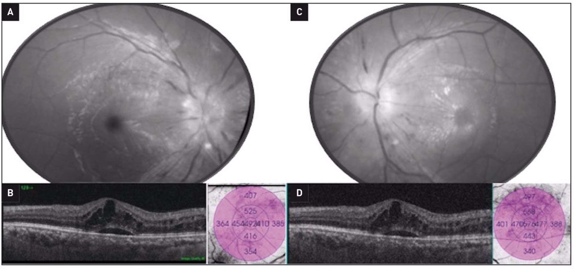 Figure 2. Œdème maculaire diabétique associé à une hypertension artérielle (HTA). Le traitement de cette HTA en parallèle du traitement ophtalmologique est indispensable afin d’éviter une non-réponse ou une réponse sous-optimale aux IVT. A et C. Rétinophotographies avec filtre vert œil droit (A) et gauche (C) retrouvant des hémorragies en flammèches péripapillaires associées à la présence de nodules cotonneux. B et D. OCT maculaire associant un DSR à un œdème intrarétinien œil droit (B) et gauche (D) à l’origine d’un épaississement rétinien central. 
