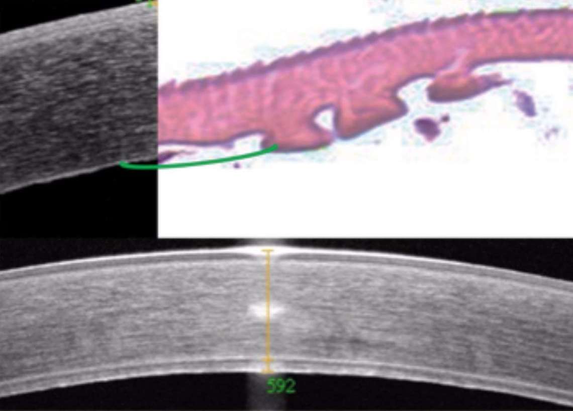 Figure 3. Aspects de la dystrophie de Fuchs au stade d’œdème stromal. La membrane de Descemet est épaissie et hyperréflective en OCT Spectral Domain. L’histologie de la Descemet prélevée lors de la greffe endothéliale en haut montre les gouttes. À ce stade, une greffe endothéliale permettra une bonne récupération visuelle. L’image du bas montre une membrane de Descemet très épaissie (69 µm contre 10-15 µm en temps normal) et multilamellaire.&nbsp;
