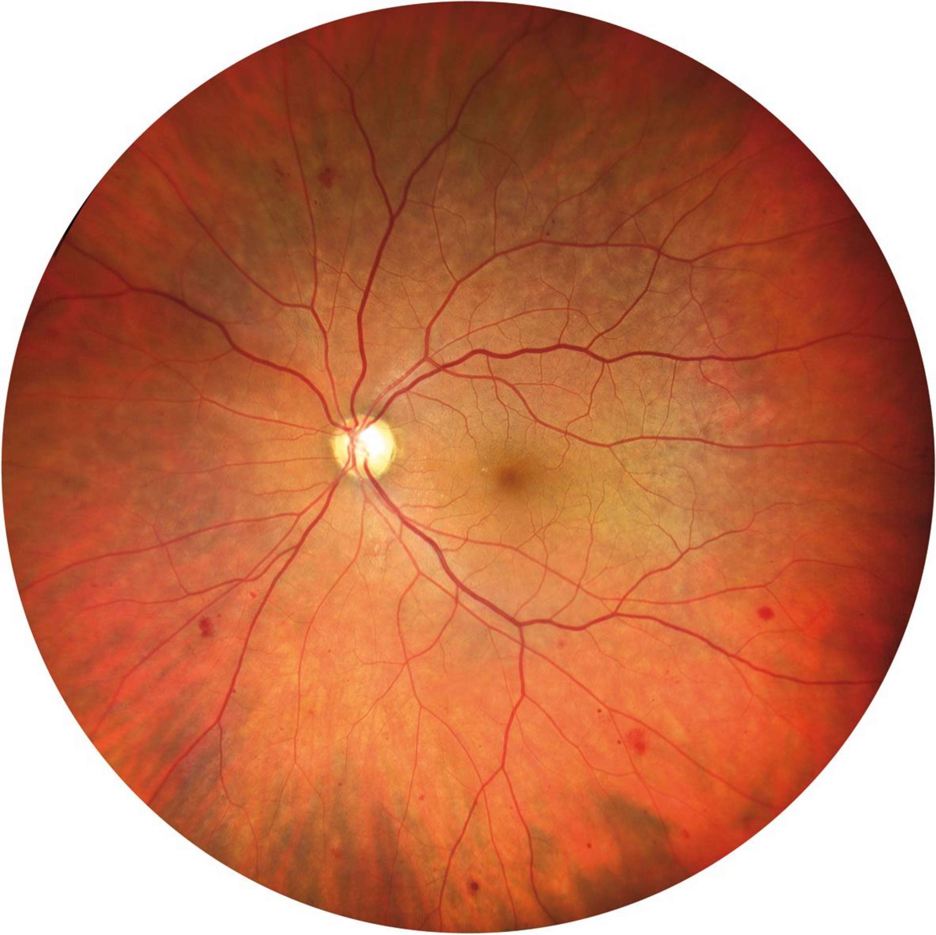 Figure 1. Rétinophographie couleur grand champ (Clarus, Zeiss) d’un patient diabétique présentant des lésions périphériques ­prédominantes.
