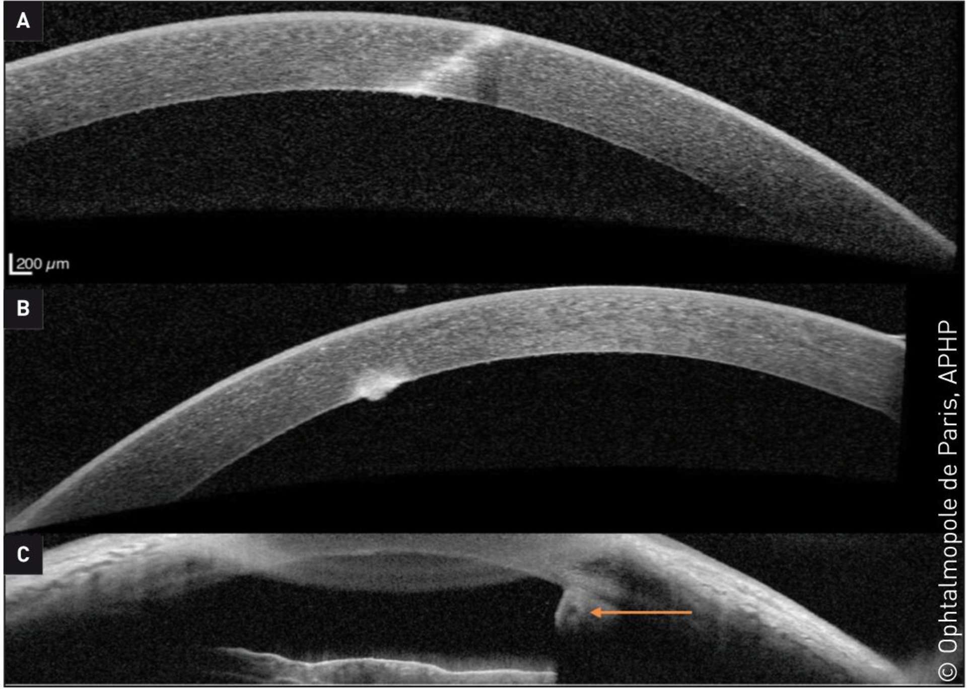 Figure 2. OCT cornéen préopératoire du patient de 17 ans ayant subi un traumatisme cornéen transfixiant d’origine végétale.
A. Hyperréflectivité cornéenne mettant en évidence le caractère ­transfixiant de la plaie B. Hyperréflectivité rétro- et prédescemétique mettant en évidence l’infiltrat postérieur C. Hyporéflectivité arrondie ­rétrocornéenne mettant en évidence le CE (flèche orange).
