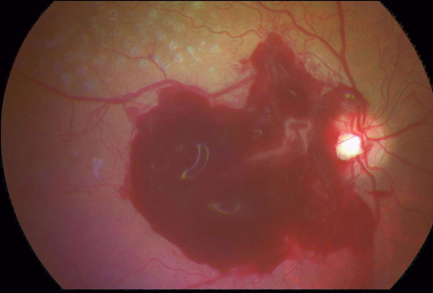 Figure 3. Hématome maculaire, indication de vitrectomie urgente.
