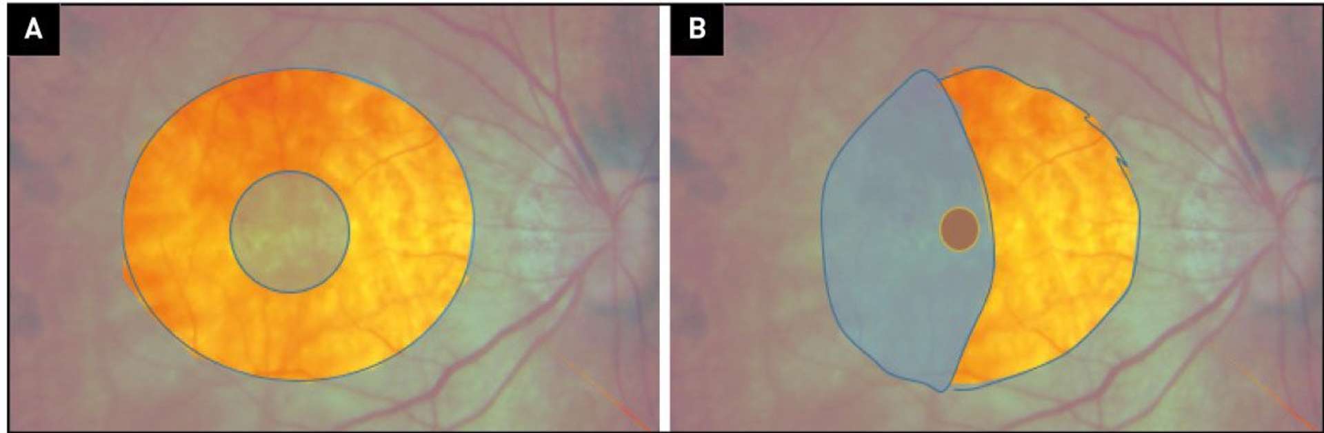 Figure 4. Techniques récentes proposées dans la chirurgie maculaire des myopes forts. A. La technique du fovea sparing dans la chirurgie du FS limite les risques de survenue du TM postopératoire : la limitante interne, colorée en bleu, est disséquée au niveau de la macula mais un patch central de limitante est laissé en place. B. Dans les TM du myope, certains auteurs recommandent de recouvrir le trou avec un volet (flap) de limitante interne pour favoriser la fermeture du trou.
