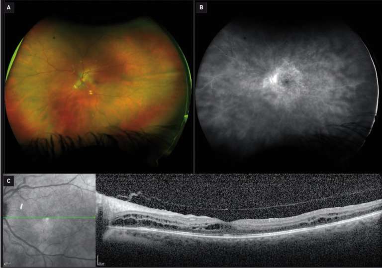 Figure 2. A. Photographie du fond d’œil. B. Angiographie rétinienne à la fluorescéine. C. Tomographie en cohérence optique. Vascularite diffuse associée à un œdème maculaire et un œdème papillaire secondaire à une syphilis.
