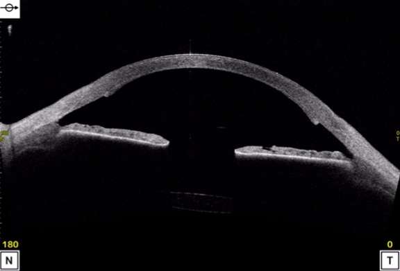 Figure 2. M3 post-DSAEK : greffon endothélial correctement collé et clair en imagerie CASIA.
