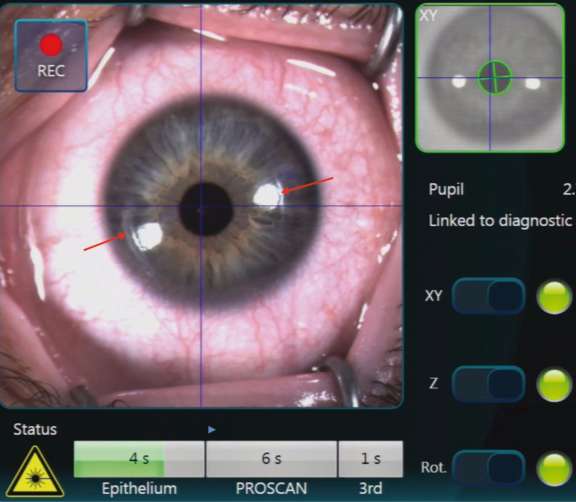 Photokératectomie réfractive : le retour