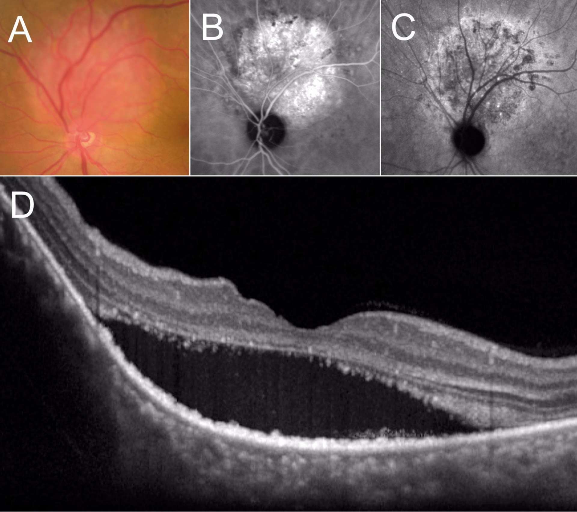 Figure 5. A. Rétinophotographie montrant une lésion choroïdienne achrome rose-orangé. B. Angiographie ICG précoce montrant une hyperfluorescence diffuse témoignant d’une lésion hypervascularisée. C. Angiographie ICG tardive montrant une hypofluorescence (phénomène de « wash-out »). D. OCT maculaire (coupe verticale) montrant un DSR et une masse choroïdienne induisant un soulèvement de l’épithélium pigmentaire en supérieur.
