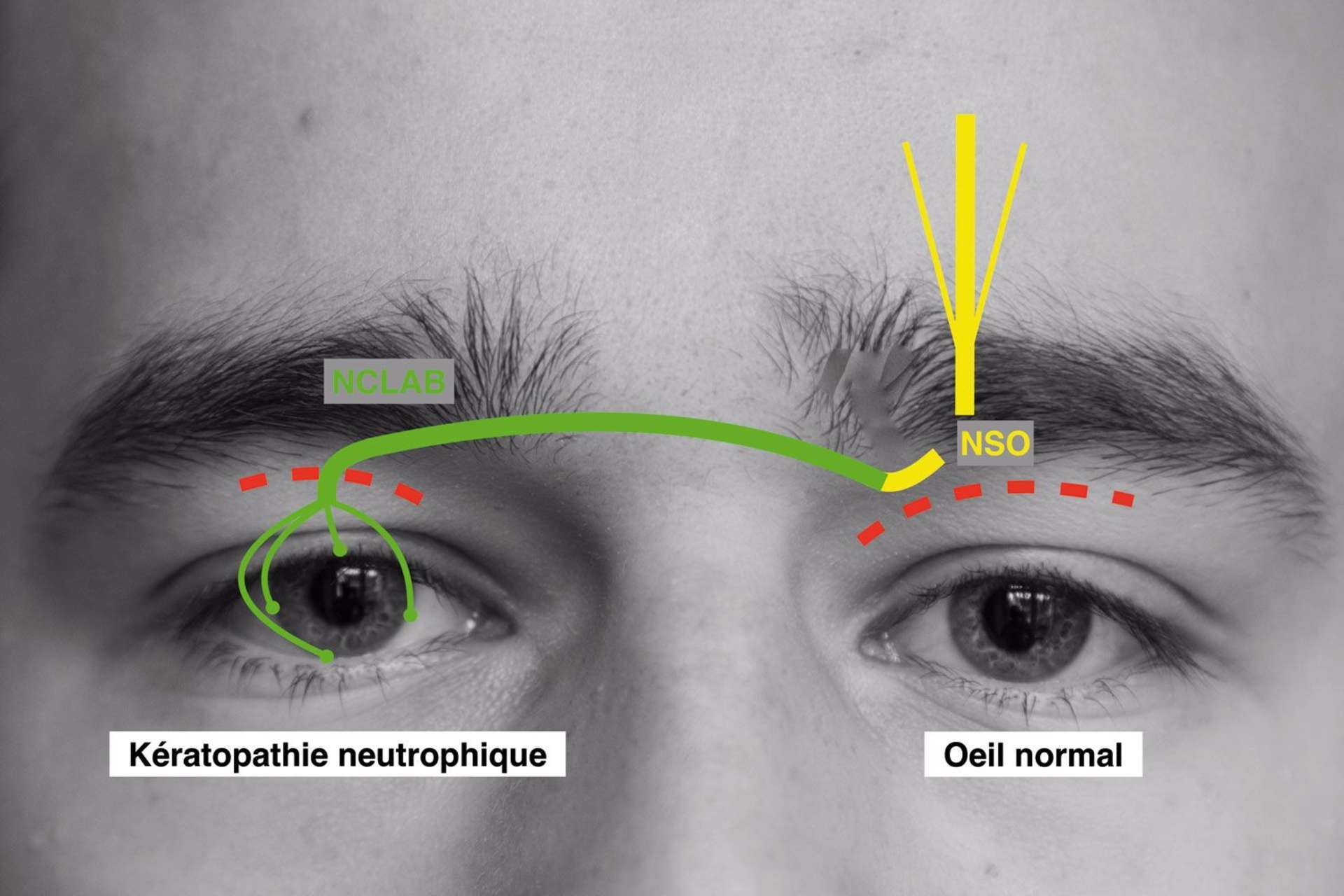 Figure 2. Représentation schématique de la procédure MICORNE. Après le prélèvement du nerf cutané latéral de l’avant-bras (NCLAB, vert) et la section du nerf supraorbitaire controlatéral (NSO, jaune), une anastomose termino-terminale est réalisée entre ces 2 nerfs. La partie distale du nerf cutané latéral de l’avant-bras et ses branches sont ensuite tunnélisées par voie sous-cutanée et sous-conjonctivale pour atteindre le limbe de l’œil atteint de la KNT afin d’y être suturées. Les incisions sont représentées en pointillés rouges.
