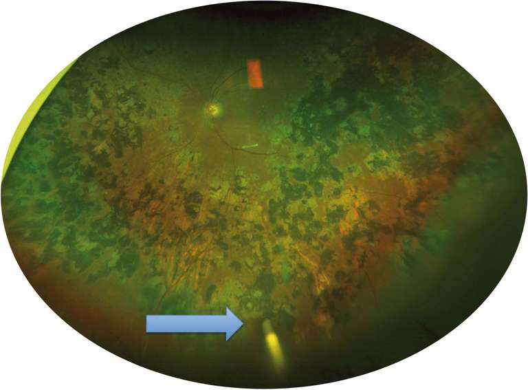 Figure 4. Rétinographie couleur grand champ de l’œil gauche. On visualise l’implant de fluocinolone (flèche bleue).
