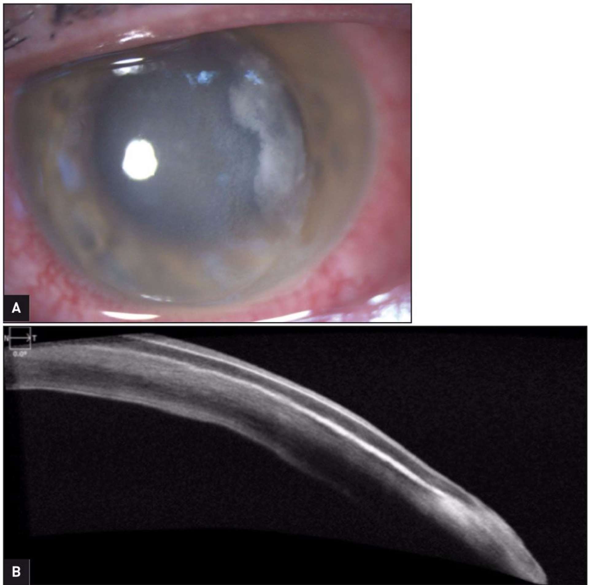 Figure 1. A. Aspect à la lampe à fente : cercle périkératique, œdème cornéen, berges temporales du volet irrégulières, infiltrat de l’interface. B. Cliché OCT cornéen : hyperréflectivité des berges, de l’interface et du stroma sous-jacent.
