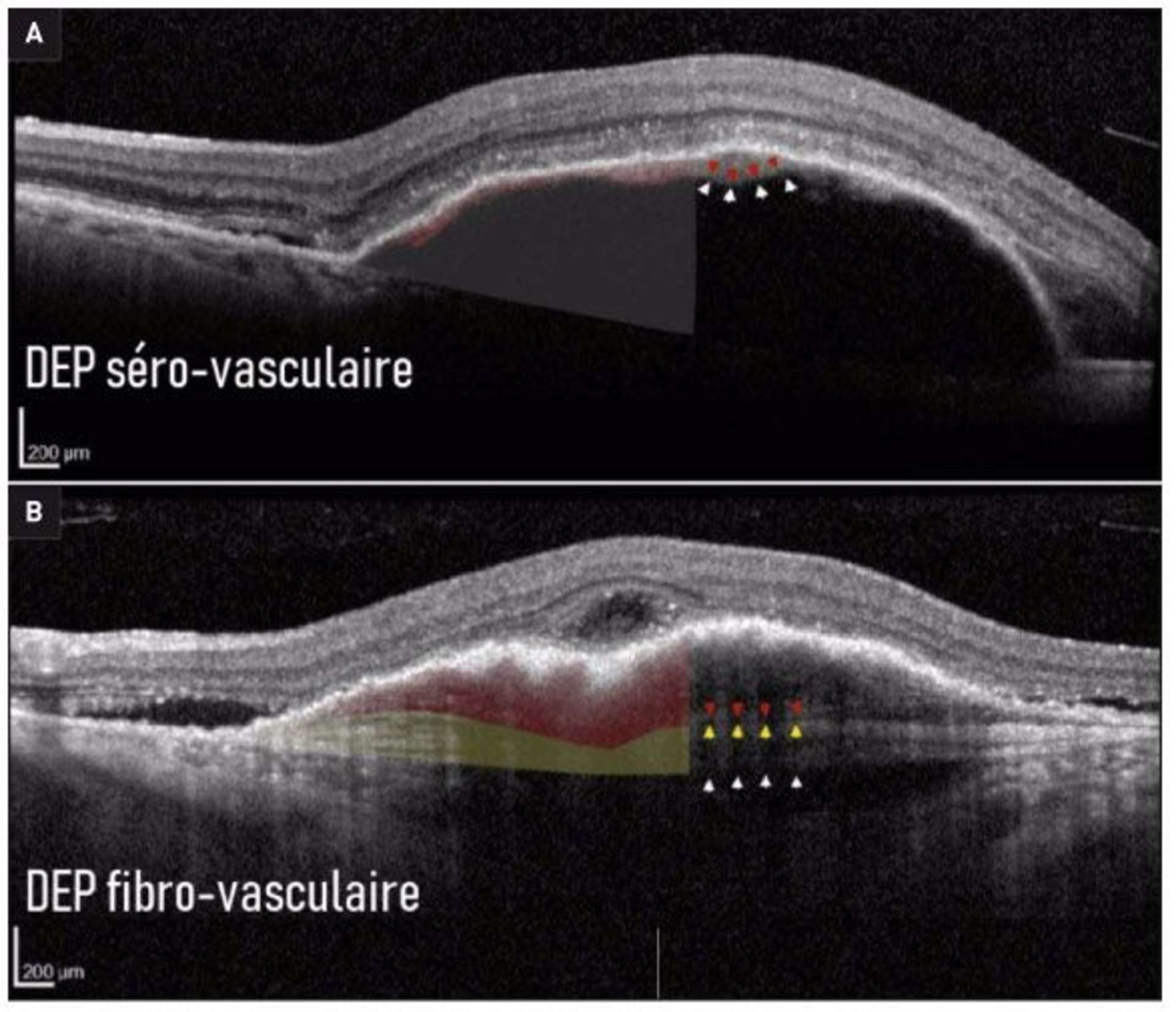 Figure 3. A. DEP sérovasculaire avec le contingent néovasculaire discrètement hyperréflectif immédiatement sous l’EP (flèches rouges), nettement séparé du contingent séreux sous-jacent (flèches blanches). B. DEP fibrovasculaire multicouches. Les auteurs distinguent un contingent fibrovasculaire (flèches rouge) sous l’EP, avec un aspect hyper- à isoréflectif irrégulier et hétérogène. Immédiatement sous ce contingent, on note une bande hyperréflective correspondant au contingent fibrocellulaire (flèches jaune) qui sera peu modifié lors des retraitements par anti-VEGF. Enfin, le contingent externe proche de la choroïde apparaît hyporéflectif (flèches blanches) [5].
