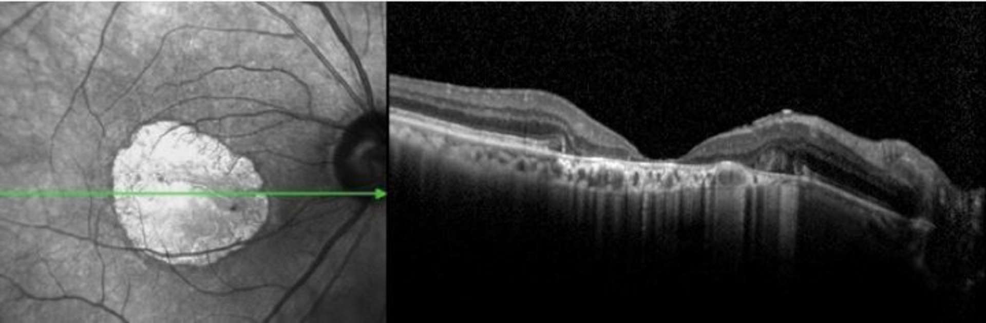 Figure 3. Atrophie maculaire en OCT. Il existe une perte tissulaire centrale sans épargne fovéale au détriment de la rétine ­neurosensorielle.
