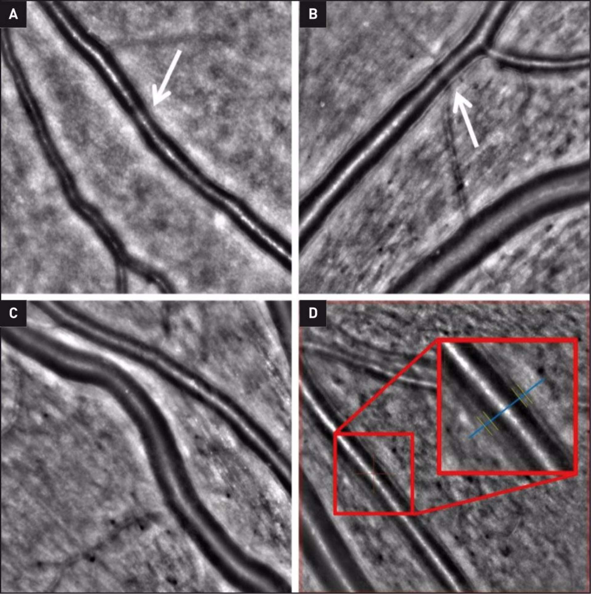 Figure 2. Optique adaptative d’un homme de 45 ans présentant un CADASIL. Rétrécissements artériolaires focaux (A) et généralisés (B), indiqués par les flèches blanches. Croisement artérioveineux (C) et mesure du rapport lumière/paroi (WLR) dans un segment d’artère (D) : la ligne bleue indique le point où la mesure a été effectuée, tandis que les lignes jaunes représentent les bords internes et externes de la paroi du vaisseau. Le WLR était de 0,38, supérieur à la moyenne des valeurs chez les sujets témoins du même âge (environ 0,28).
