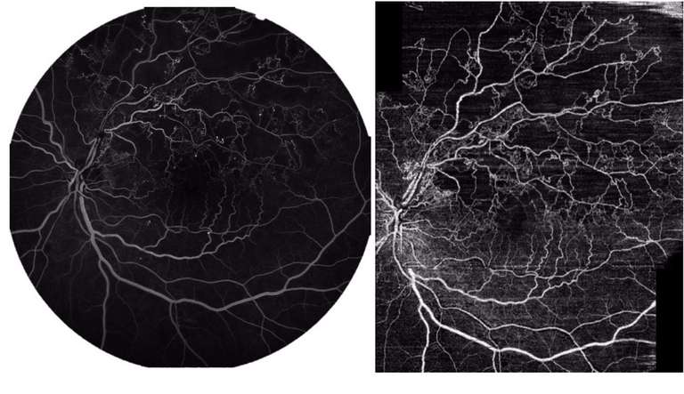 Figure 4. Comparaison entre une image d’angiographie à la fluorescéine à gauche réalisée sur un champ de 55° à l’aide du Spectralis HRA-OCT2 d’Heidelberg et d’une mosaïque grand champ de 2 images d’OCT-A de 12 x 12 mm obtenues grâce au DRI TritonTM de Topcon à droite. Les zones de non-perfusion en lien avec l’occlusion veineuse sont superposables sur les 2 modalités d’imagerie.
