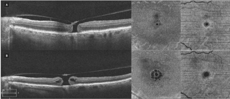 Figure 2. A. Examen initial. B. Examen préopératoire avec, de gauche à droite : B-Scan, OCT en face au collet, OCT en face à la base. Coupe OCT en follow-up et OCT en face d’un TM de 246 µm qui s’est élargi de 96 µm au collet et de 136 µm à la base après un report chirurgical de 17 semaines.&nbsp;
